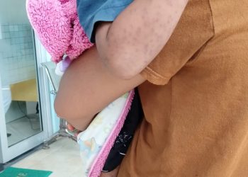 Samarinda Waspada Campak, Dinkes Catat 72 Kasus Suspek Mayoritas Anak Belum Imunisasi