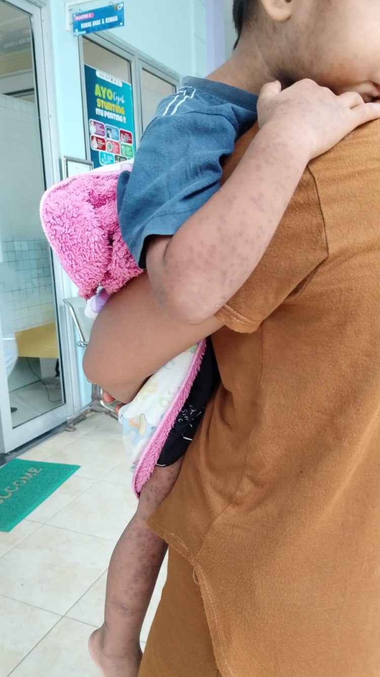 Samarinda Waspada Campak, Dinkes Catat 72 Kasus Suspek Mayoritas Anak Belum Imunisasi